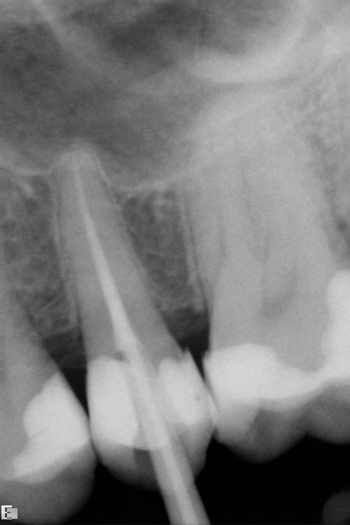 diente endodonciado.